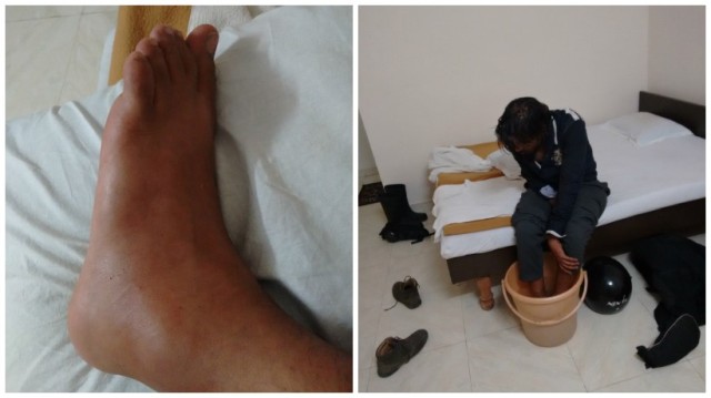 foot swelling on long ride leh ladakh